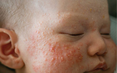 Baby Acne – causes and treatment